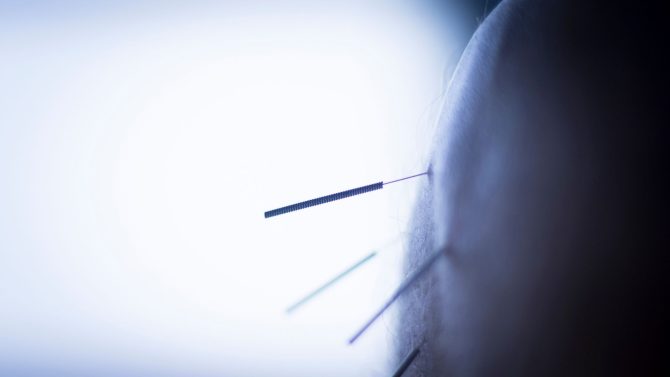 Akupunktur ile Alakalı Bilmeniz Gerekenler