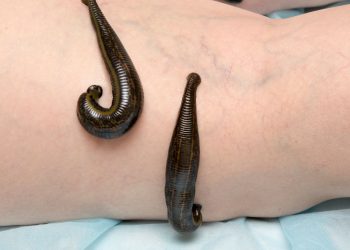 Buca Sülük Tedavisi